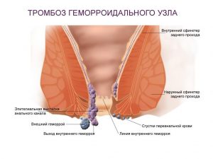 Острый тромбоз геморроидальных узлов