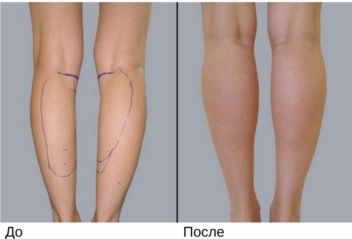 Круропластика ног. Круропластика голени асимметрия голени. Круропластика голени операция. Исправление кривизны ног круропластика. Пластика ног (круропластика).