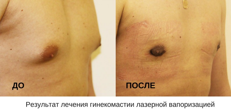 до и после лечения гинекомастии лазерной вапоризацией