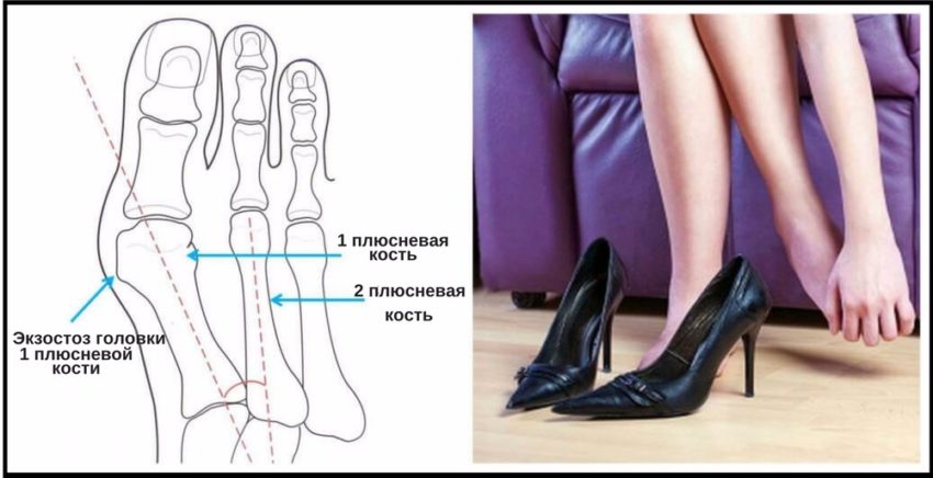 симптомы косточки на ноге