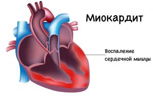 Миокардит сердца
