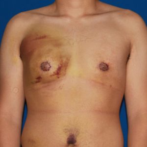 осложнения после липосакции груди