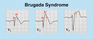 Синдром Бругада на ЭКГ