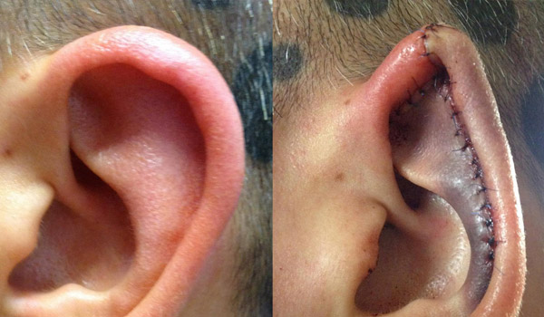 Осложнения после операции эльфийские уши