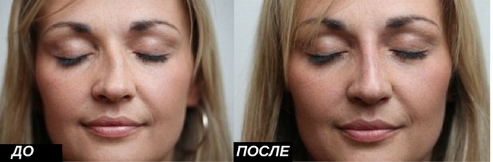 ринопластика: исправление кривизны носа
