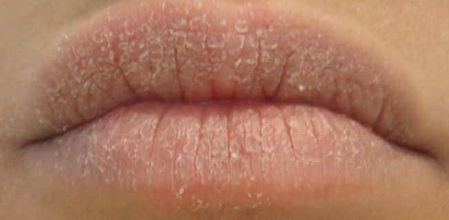 причины жжения губ