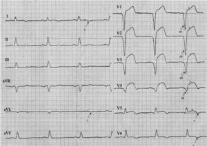 Трансмуральный инфаркт миокарда на ЭКГ