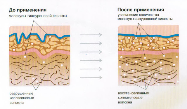 влияние гиалуроновой кислоты на кожу