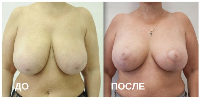 до и после операции по исправлению опущения молочных желез