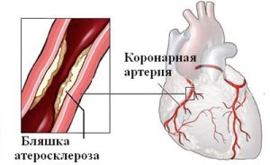 Атеросклероз коронарных артерий
