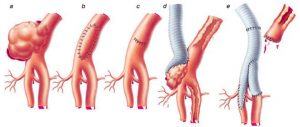Резекция аневризмы артерии