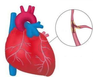Заболевание сердца стенокардия