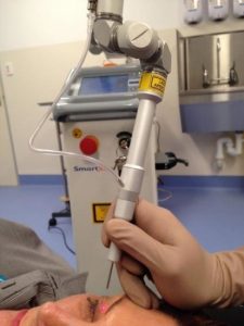 лазерная блефаропластика: аппарат для проведения