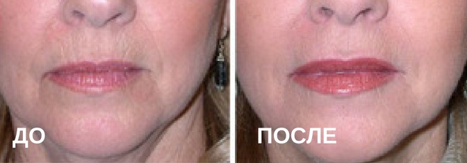 Удаление малых губ до и после фото. Уголки губ ботокс до и после. Поднятие уголков губ ботоксом.