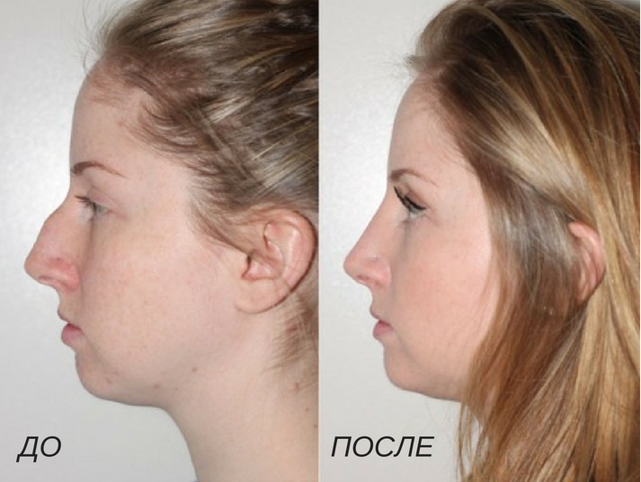 ринопластика: коррекция горбинки носа