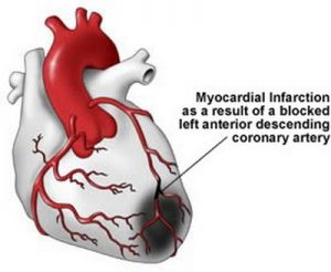 Приступ инфаркта миокарда