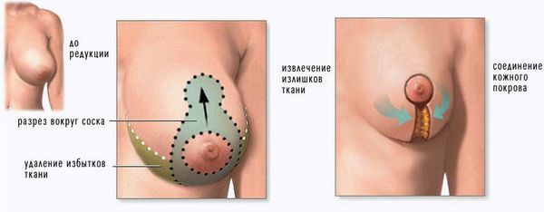 альтернатива липосакции груди