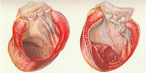 Аневризма сердца