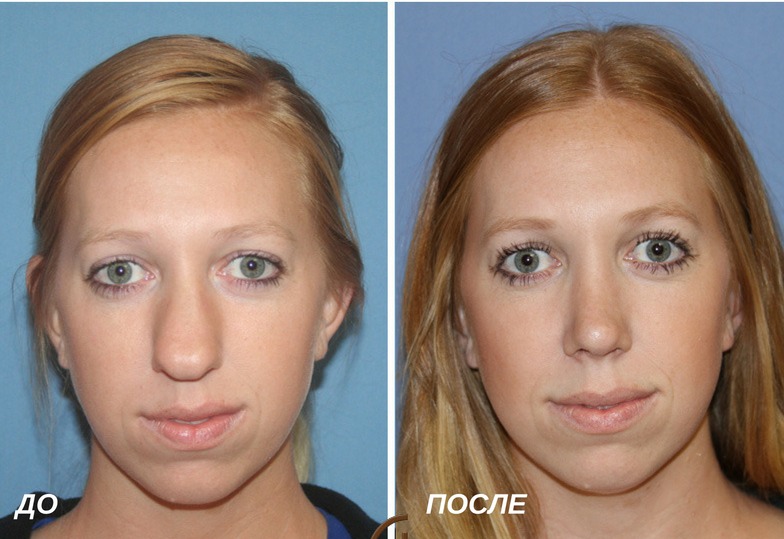ринопластика: сужение спинки носа