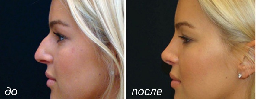 Сколько стоит операция на горбинку носа. Ринопластика горбинки носа. Абдулнасир Самедович ринопластика. Леди Гага ринопластика. Ринопластика носа с горбинкой до и после.