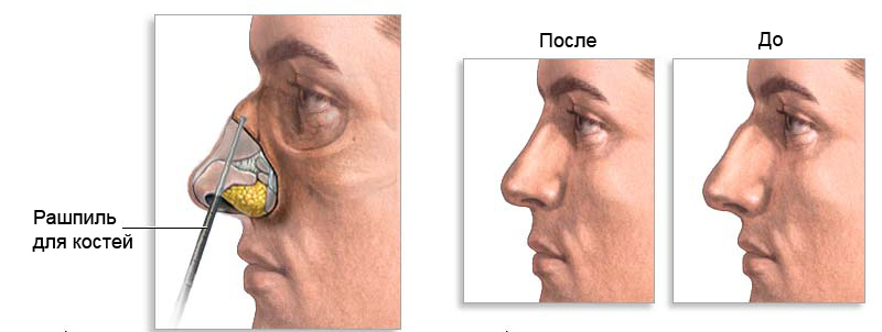 Исправление носа хирургически