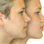 метод коррекции носа