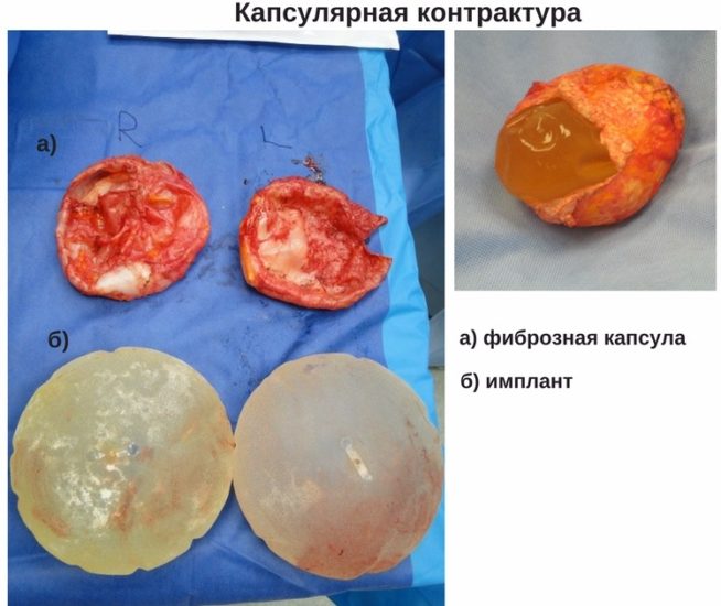 осложнения после маммопластики