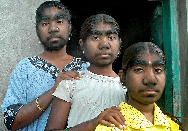 сестры индианки с гипертрихозом