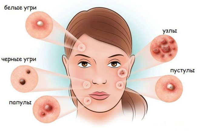 гормоны влияющие на кожу