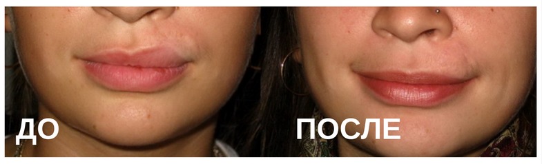 Изменение формы губ: до и после