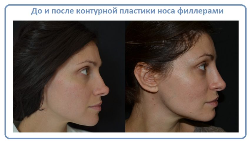 до и после контурной пластики носа