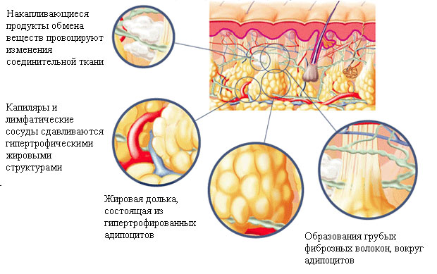 механизм развития целлюлита и варикоза