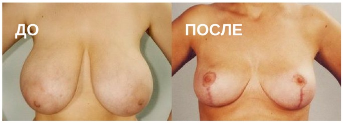 до и после оперативных вмешательствах на груди