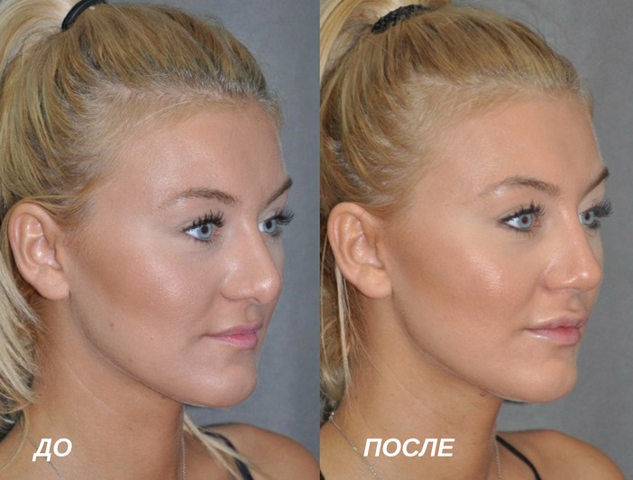 до и после ринопластики носа
