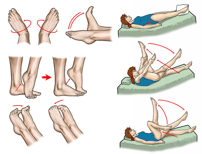 профилактика прогрессирования варикоза ног