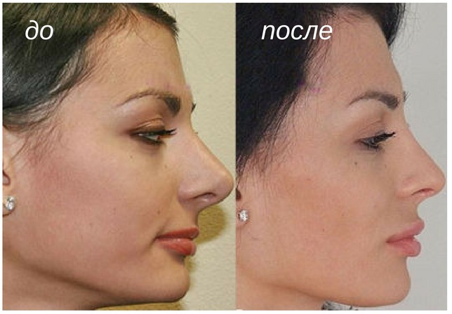 уменьшение длины носа
