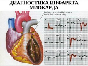 Симптомы инфаркта на ЭКГ