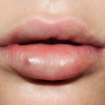 шарики в губах после введения гиалуроновой кислоты