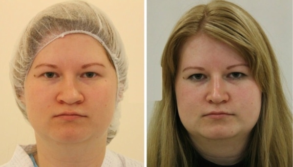 до и после уменьшения ноздрей