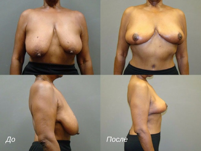 липосакция при ассиметрии груди