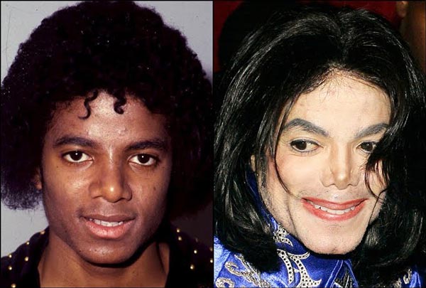 до и после пластики Майкл Джексон