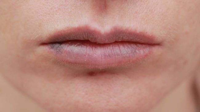 причины жжения губ
