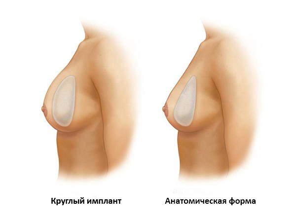 круглый и анатомический имплант в груди