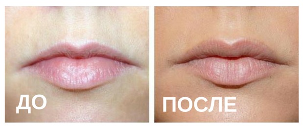 Увеличение губ: до и после