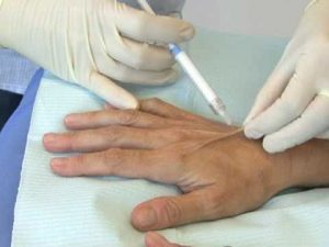 особенности проведения мезотерапии рук
