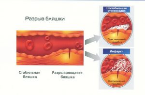 Проявления нестабильной стенокардии