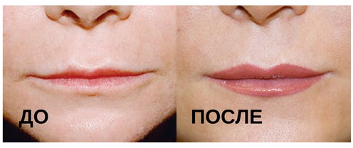Увеличение тонких губ: до и после