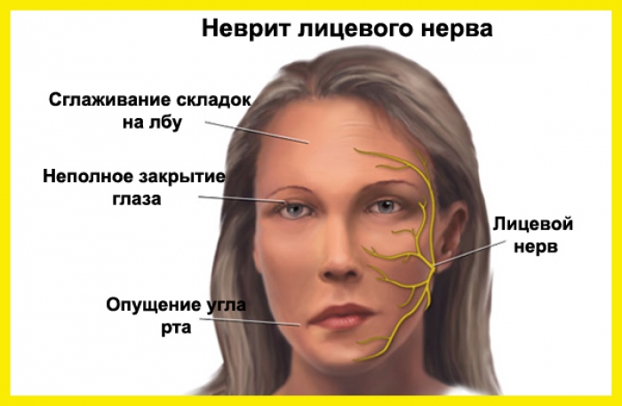 неврит лицевого нерва
