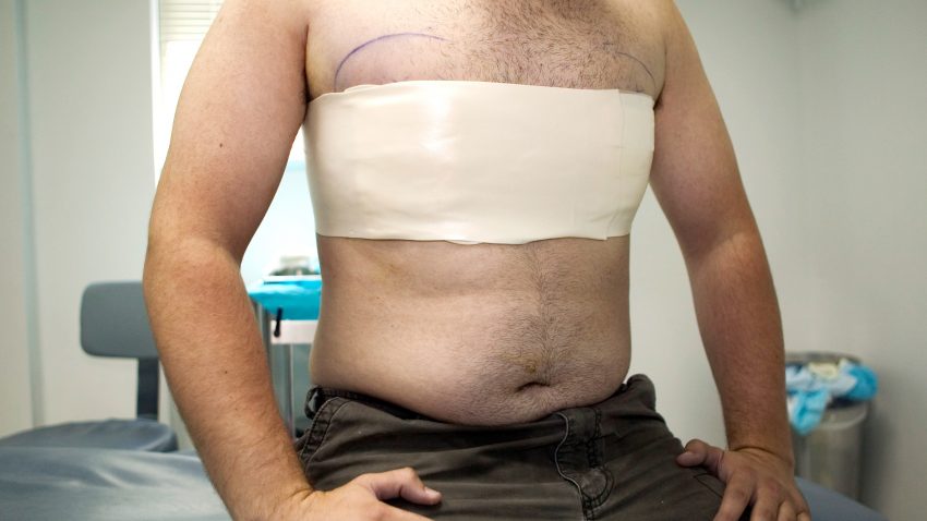 липомастия удаление жира из груди у мужчины