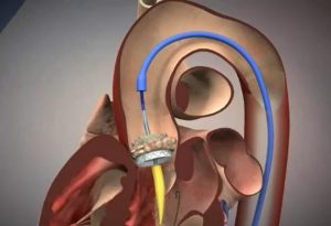 Операции при стенозе аортального клапана